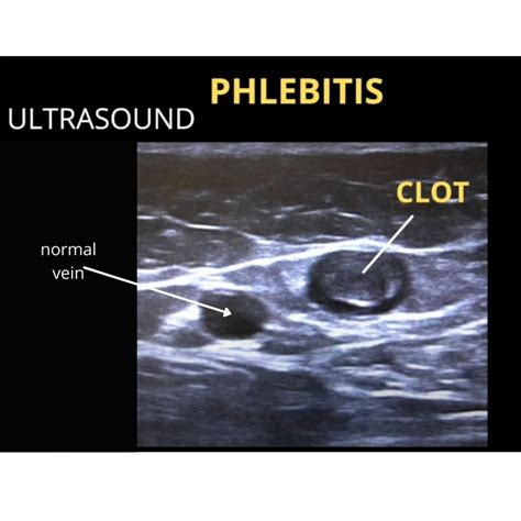 What Does A Blood Clot Look Like In Ultrasound