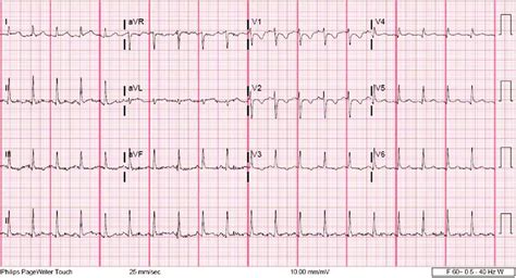what does a borderline ecg mean