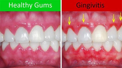 What is Gingivitis? Stonehill Dental Hamilton Dentist