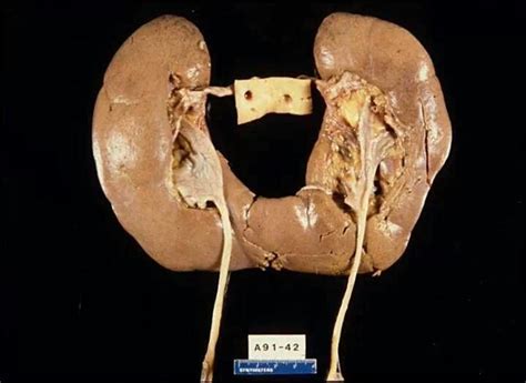 what does a horseshoe kidney look like