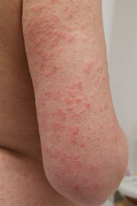what does a rash from sun exposure look like
