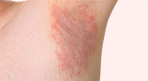 what does a rash on your armpit mean