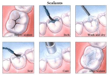 What Does A Sealant Do