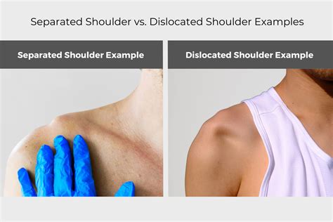what does a separated shoulder feel like