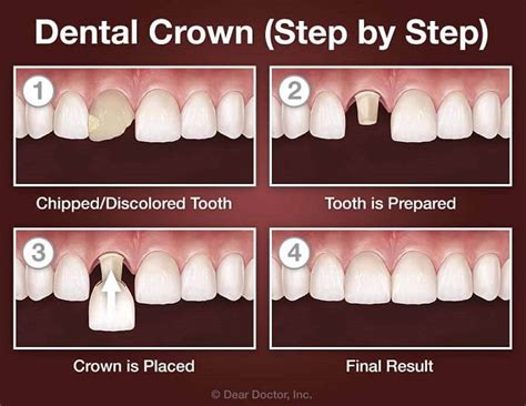 What Does A Temporary Crown Cost
