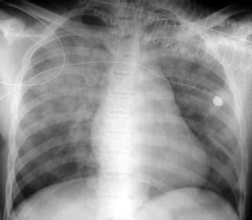 what does airspace disease mean in lung