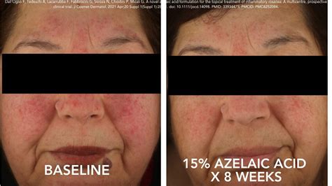 What Does Azelaic Acid React With