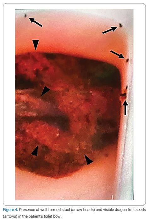 What Does Beets Look Like In Stool