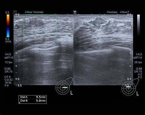 what does breast cancer look like on ultrasound