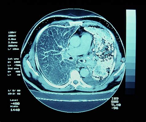 what does cancer look like on a ct scan