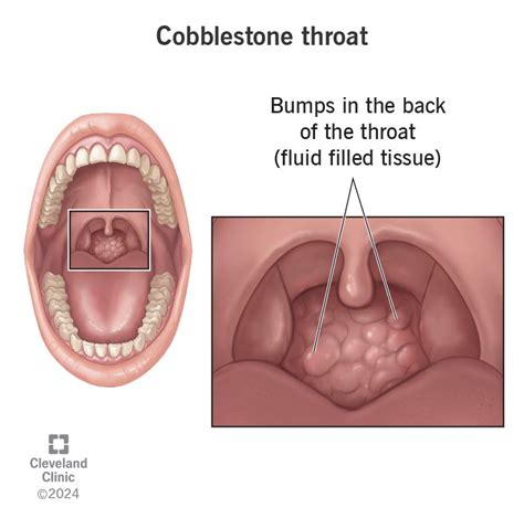 What Does Cobblestone Throat Indicate