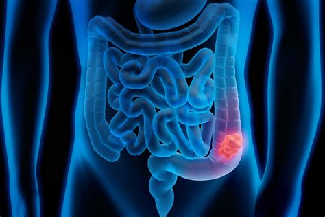 what does colon cancer back pain feel like