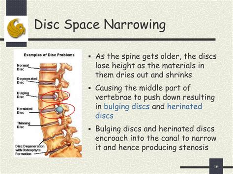 What Does Disc Space Mean
