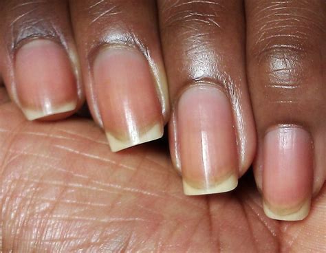 What Does Discolored Cuticles Mean