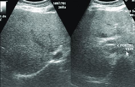 What Does Echotexture Mean