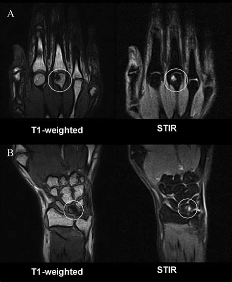 what does edema look like on mri