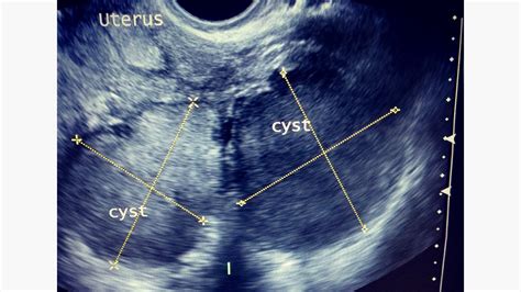 what does endometriosis look like on sonogram