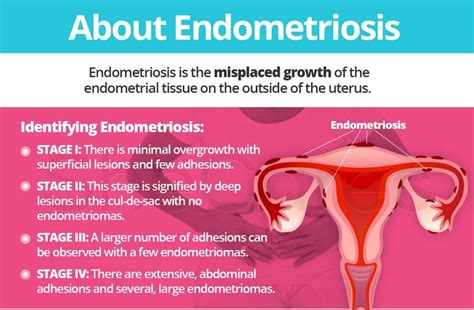 what does endometriosis mean for.me