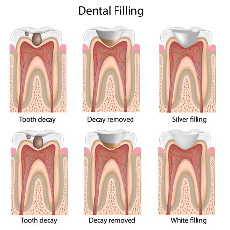 What Does Filling Mean Dentist