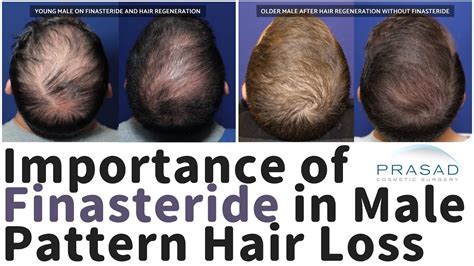 what does finasteride do to men