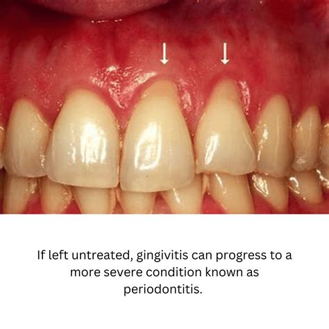Spotting Gingivitis: Unveil Visual Clues