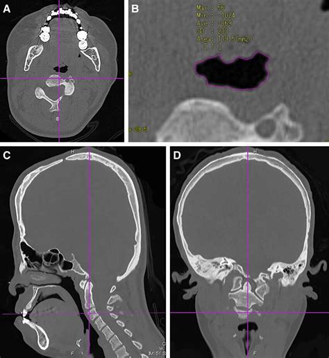 What Does Indication Mean On Ct Report