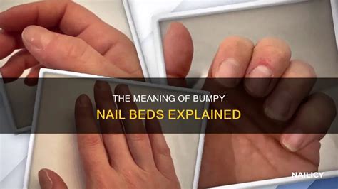 What Does It Mean When Your Nail Beds Are Bumpy