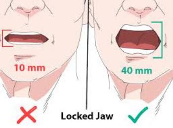 What Does Lockjaw Feel Like