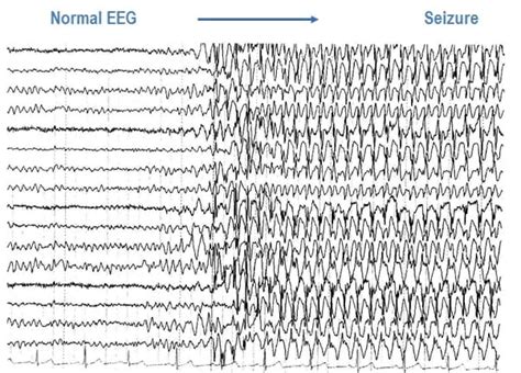 what does photosensitive epilepsy feel like
