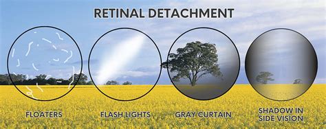 What Does Shimmering Vision Mean