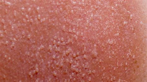 what does slight sun poisoning look like