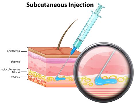 Uncovering the Basics: What Does Subcutaneous Mean in Medical Terms?