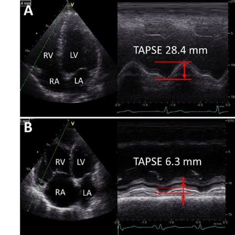 What Does Tapse Mean On Echo