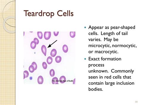 What Does Teardrop Cells 1+ Mean