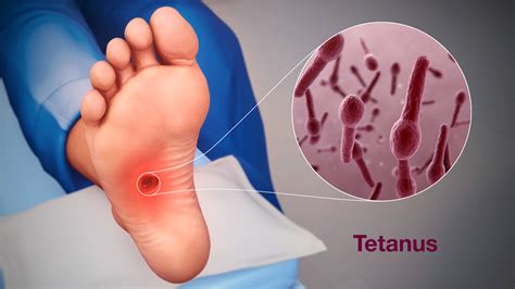 Tetanus Symptoms: What Does Tetanus Look Like in Adults?