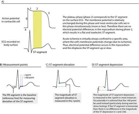 what does the st segment represent in an electrocardiogram