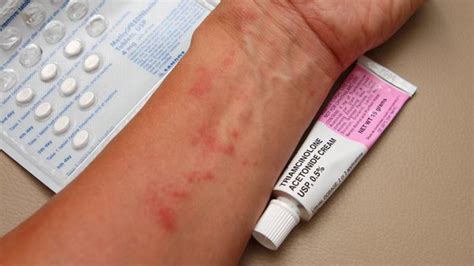 Unlocking the Power of Triamcinolone Acetonide: What Does Triamcinolone Acetonide Do for Skin and Health?