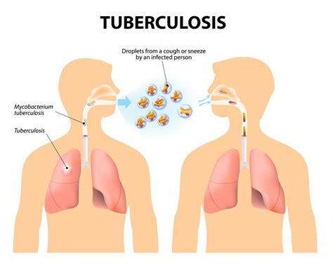 what does tuberculosis do