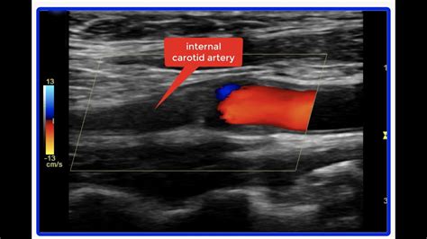 what does ultrasound of carotid artery show