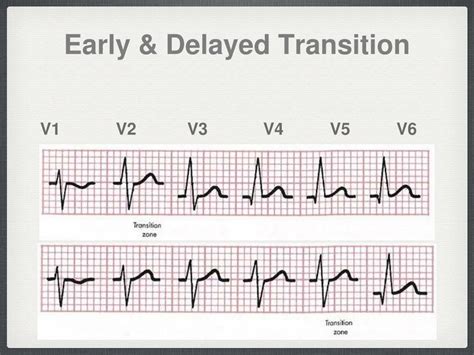what does v1 v2 v3 v4 v5 v6 mean on ecg