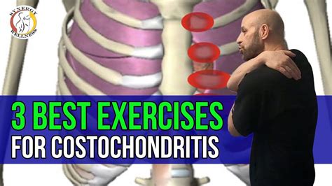 What Exercises To Avoid With Costochondritis