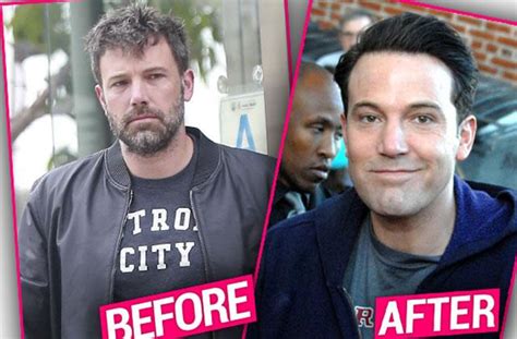 what happened to ben affleck's face