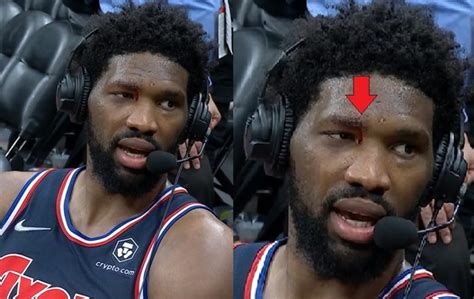 what happened to joel embiid eye