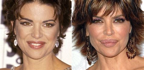 what happened to lisa rinna's face