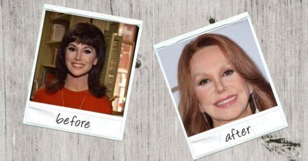 Marlo Thomas Plastic Surgery With Before And After Photos