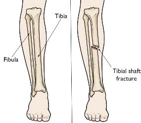 what happens if you break your tibia