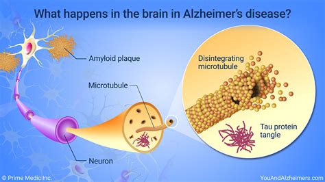 what happens to the nervous system when you have alzheimer