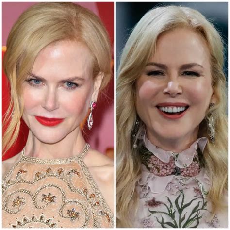 what has happened to nicole kidman's face