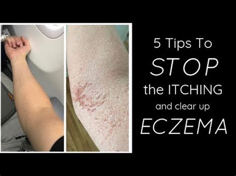 what if eczema doesn't go away