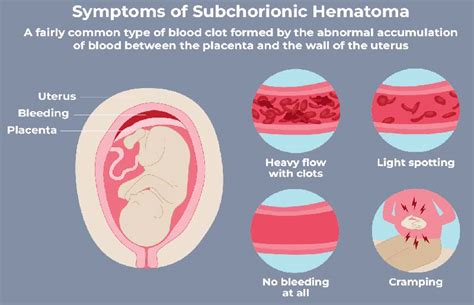 Understanding What Irritates a Subchorionic Hematoma During Pregnancy